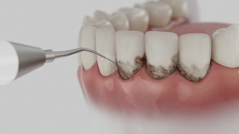 Trusted Wisdom Tooth Removal service in Mound Bayou, MS - Dentist Open Now